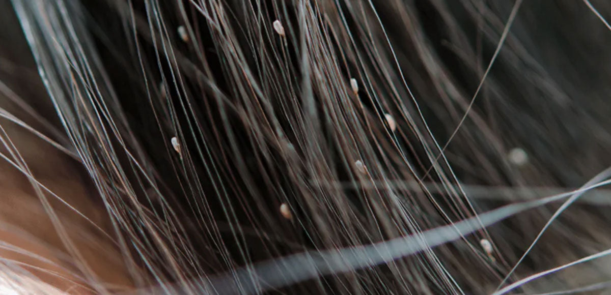 How Do I Remove Lice Eggs? – Licefreee