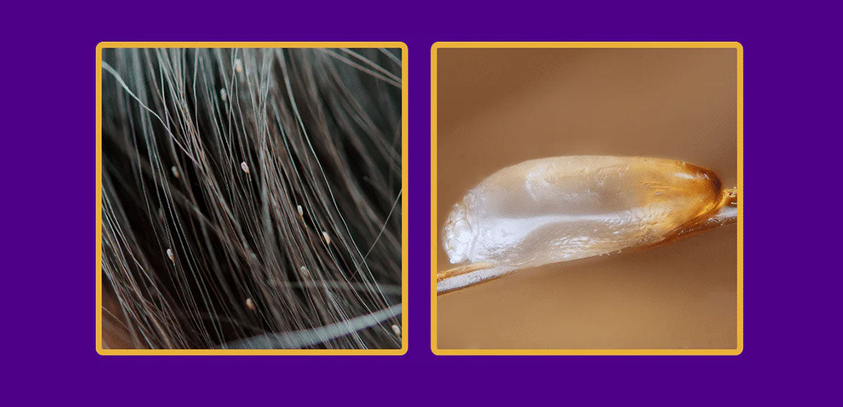 Nit Shells What Nits Look Like and How to Get Rid of Them – Licefreee