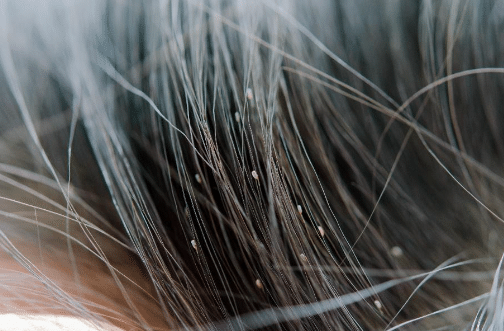 A portion of human hair insfested with nits.